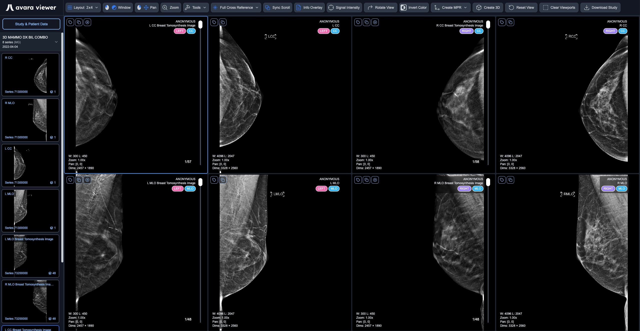 Mammography Hanging Protocol Layout